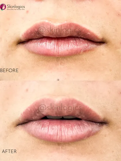 Here is another example of my lip filler work. You can see the subtle increase in volume and improved symmetry, resulting in lips that look naturally plump and well-defined.