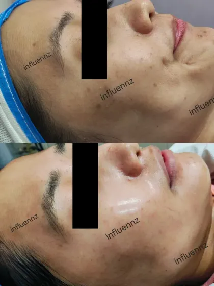 This image shows the 'after' glow, with skin appearing more hydrated, plump, and radiant following a rejuvenating treatment designed to improve overall skin health.