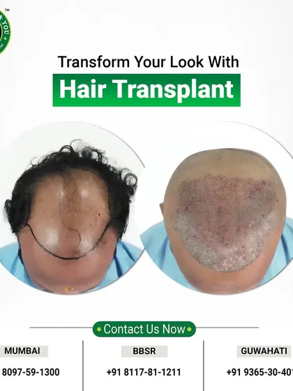 This graphic shows the immediate before and after of the FUE procedure. You can clearly see the area of baldness covered with newly implanted grafts, ready to begin the growth phase.