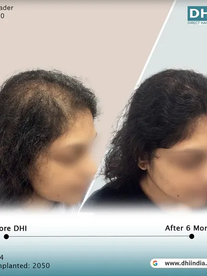 Another side-profile view of the same client's 6-month progress. The restored hairline and increased thickness are clearly visible, showcasing a natural and beautiful result.