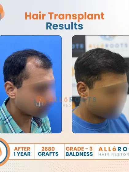 A one-year result for a Grade 3 baldness case using 2680 grafts. These images show the transformation from multiple angles, highlighting the restored density and the clean, natural hairline I designed.