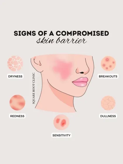 An educational infographic showing the common signs of a compromised skin barrier. These include dryness, redness, breakouts, dullness, and sensitivity, all of which we can help you address.