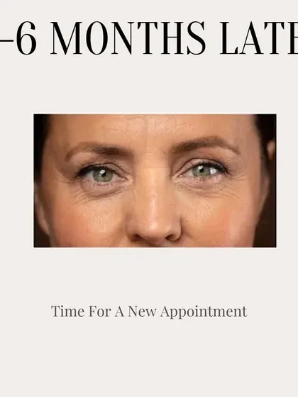This image marks 5-6 months after a Botox treatment. As the effects wear off and muscle movement returns, it's time to book your next appointment to maintain your smooth, refreshed look.