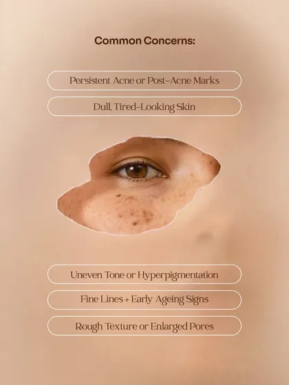 This graphic lists common concerns that indicate you might benefit from a chemical peel. These include persistent acne or post-acne marks, dull skin, uneven tone, fine lines, and rough texture or enlarged pores.