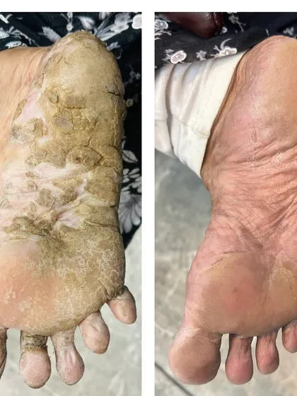 Soothing Severe Palmoplantar Keratoderma. This condition causes painful, thickened skin on the feet. This transformation shows the dramatic improvement after a customized treatment plan involving keratolytic agents and intensive moisturizing therapy.