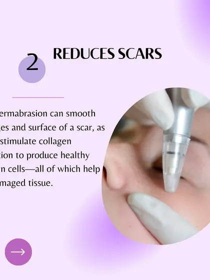 Reason 2 for Microdermabrasion: It reduces scars by smoothing their edges and stimulating collagen production to heal damaged tissue.