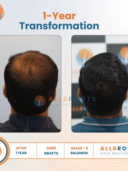 This is a one-year transformation for a Grade 5 baldness case, achieved with 3450 grafts. The before and after photos from various angles show a comprehensive restoration of the scalp, resulting in a full and natural look.