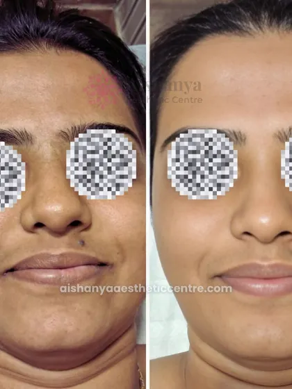 This client received a HydraFacial treatment, and the results are clear. Her skin in the 'after' photo is visibly brighter, more hydrated, and the overall tone is more even, showing the instant benefits of this popular facial.