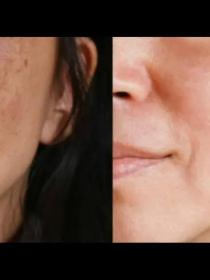 This before-and-after demonstrates a dramatic improvement in facial melasma. The key to this success was a strict skincare regimen combined with in-clinic procedures, leading to a more even and brighter skin tone.