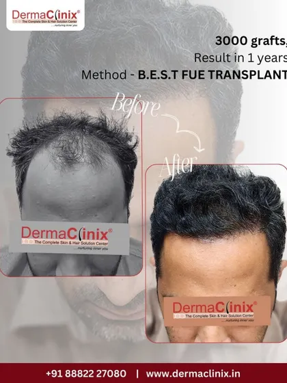 This image shows a one year result of a 3000 graft B.E.S.T. FUE transplant. The focus was on creating a dense and natural looking frontal hairline, which has been successfully achieved.