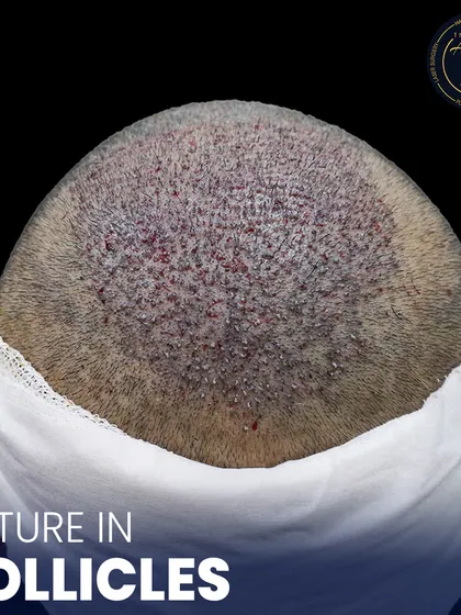 This is where science meets style. A detailed view of newly implanted hair follicles, showcasing the meticulous process of high-density hair restoration.