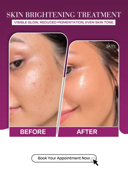 A clear before-and-after comparison demonstrating the effectiveness of my skin brightening treatments. The images show a visible reduction in pigmentation and a significant improvement in overall glow and skin tone.