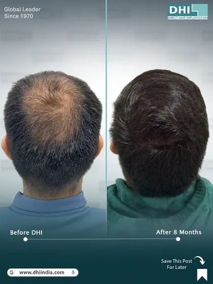 A rear view of the same patient's 8-month progress. The crown is now full and dense, demonstrating the effectiveness of our DHI technique in treating complex hair loss patterns.