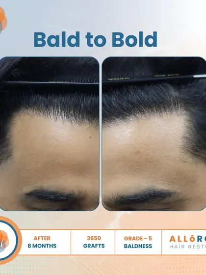 From Bald to Bold. This 8-month result for a Grade 5 case, using 3650 grafts, shows a complete transformation. The close-up of the hairline demonstrates the natural and dense packing of follicles.