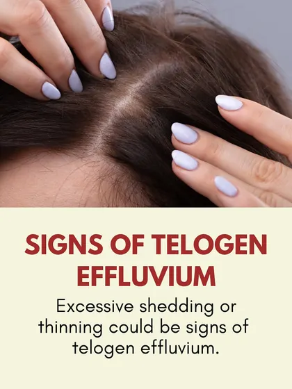 The primary sign of Telogen Effluvium is excessive shedding or noticeable thinning of the hair all over the scalp, rather than in patches.
