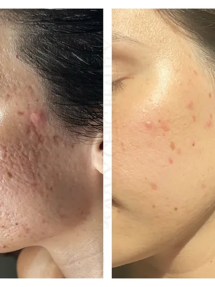 This is a powerful example of treating severe, deep-pitted acne scars. The journey required advanced resurfacing techniques to break down old scar tissue and stimulate the growth of new, healthy skin from below.