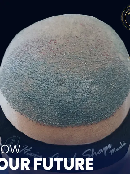 This is where science meets style. A detailed view of newly implanted hair follicles, showcasing the meticulous process of high-density hair restoration.