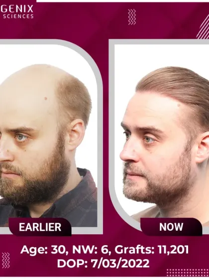 A stunning DHT hair restoration for a 30-year-old with Grade 6 baldness, requiring 11,201 grafts.