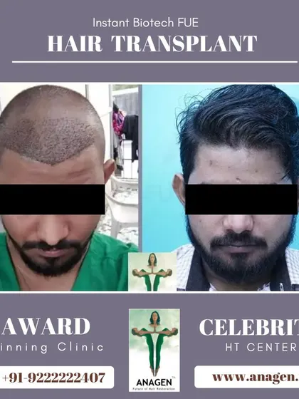 This before and after photo shows a patient's journey from post op to a full head of hair, highlighting the natural looking results of our procedures.