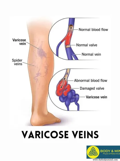 Varicose veins are enlarged, twisted veins near the skin's surface, most commonly affecting the legs.