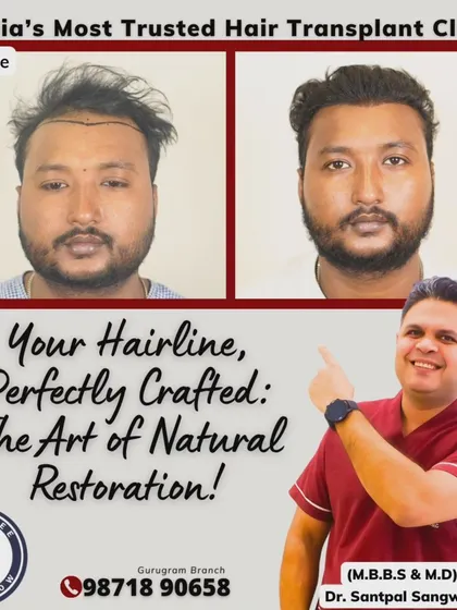 A happy patient with a perfectly crafted hairline. We used 3100 grafts to achieve this dense and natural look in just 8 months. The smile on his face says it all.