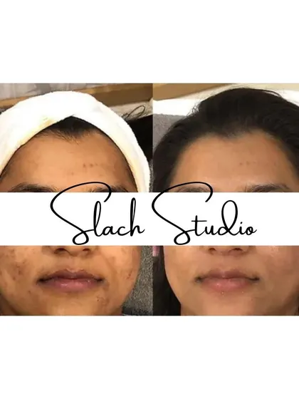 A before-and-after showing the reduction of spots and an overall brightening of the skin tone.
