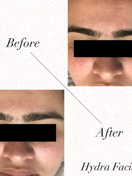 See the visible improvement in skin hydration, brightness, and complexion after just one HydraFacial treatment.