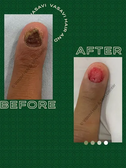 This before-and-after shows a nail surgery I performed. Conditions like severe fungal infections or trauma can damage the nail. In such cases, a surgical procedure can remove the damaged nail and allow for healthy regrowth.