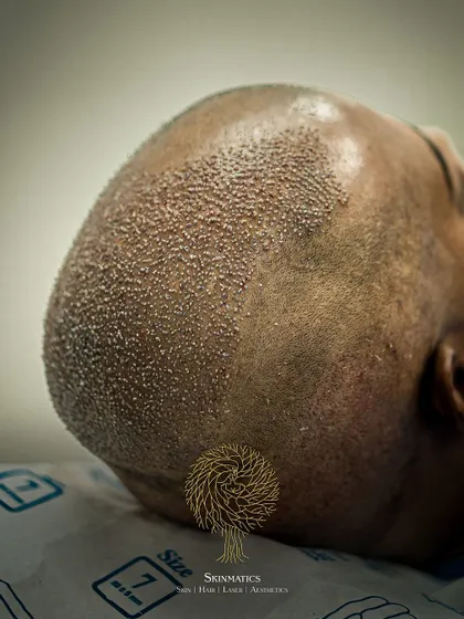 This side-profile view shows how the transplanted area seamlessly blends with the non-transplanted hair. The goal is to restore hair, not to make it look like a procedure was done.
