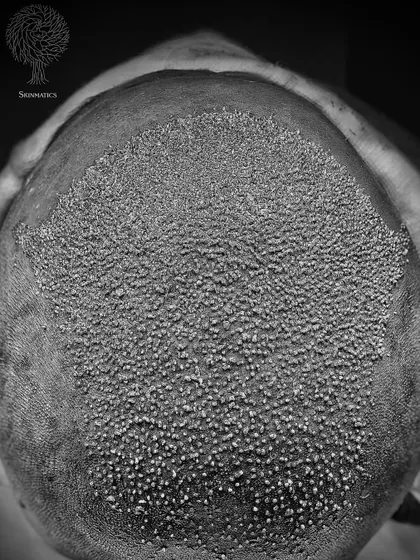 This artistic black and white shot captures the moment a new chapter begins. Each dot is a carefully placed hair follicle, representing the start of a journey back to self-confidence.