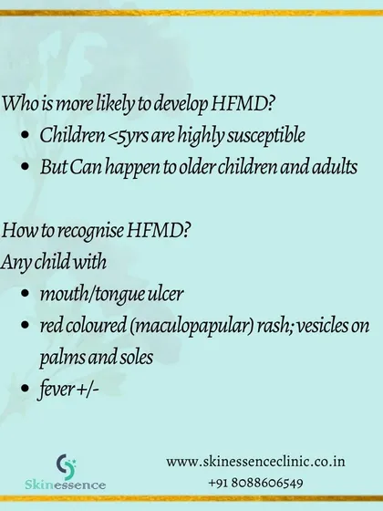 HFMD is most common in children under five, but older children and adults can get it too. Key signs to watch for are mouth ulcers, a red rash on the palms and soles, and sometimes a fever.