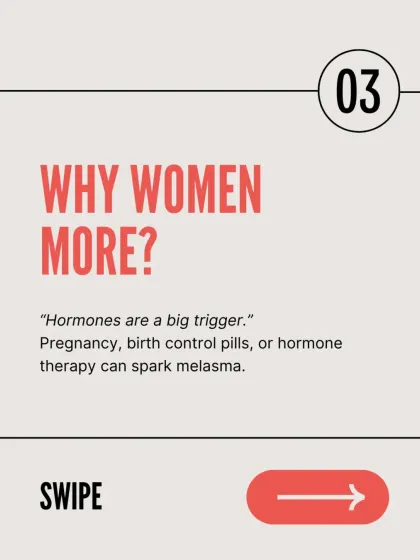 Hormonal fluctuations are a major trigger for melasma, which is why it is more common in women. Pregnancy, birth control pills, or hormone therapy can all spark its appearance.
