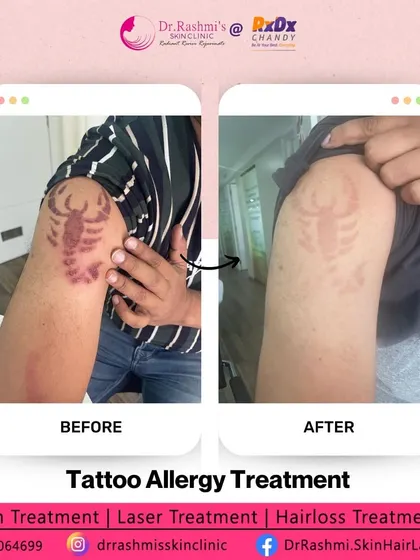 This before-and-after shows the successful treatment of a delayed allergic reaction to tattoo ink. With proper diagnosis, including patch testing, and specialized care, we can manage complex skin reactions and restore healthy skin.