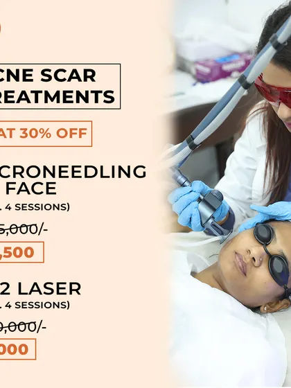 A patient undergoing a CO2 laser session for acne scar treatment. This procedure is a gold standard for resurfacing the skin and significantly diminishing the appearance of scars.