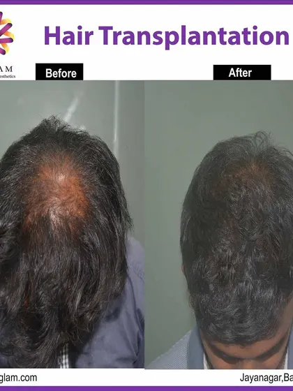 This before and after comparison demonstrates the effectiveness of our hair transplant treatment for significant thinning on the crown. The result is thicker, healthier-looking hair.