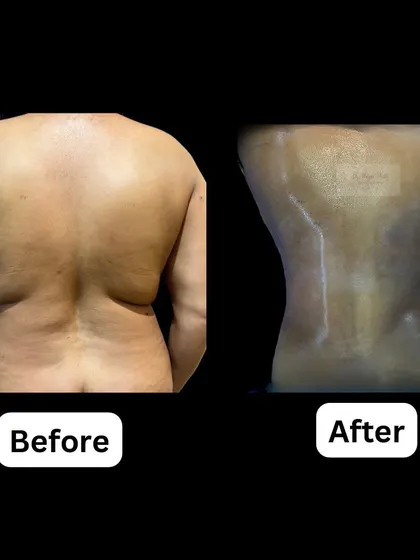 This demonstrates the power of Vaser liposuction combined with BodyTite radiofrequency technology. For this patient, we performed a revision procedure to remove stubborn fat from the back and flanks while tightening the skin, successfully restoring a defined, hourglass waistline.
