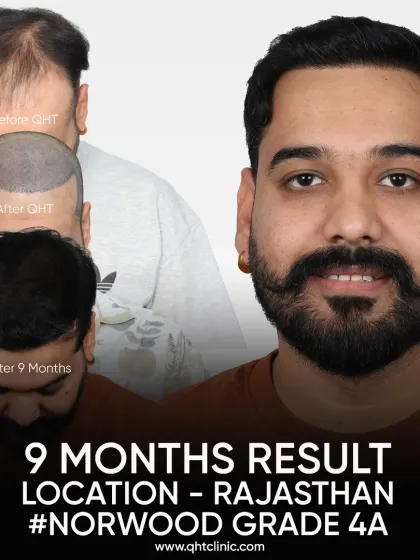 A 9-month transformation for a Norwood Grade 4A patient from Rajasthan. We used 5000 grafts to cover the hairline, frontal region, mid-scalp, and temples.