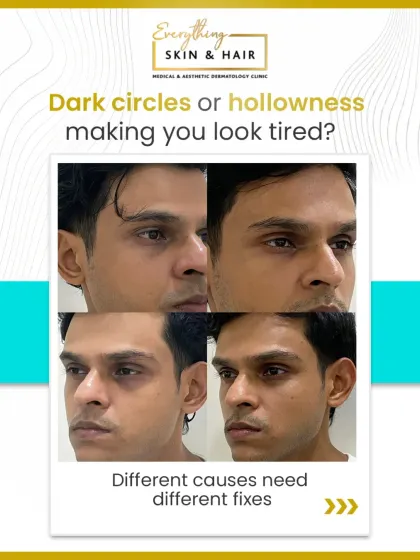 Hollowness and dark circles under the eyes can make you look tired regardless of how much you rest. Here, you can see the significant yet subtle improvement achieved by addressing volume loss, resulting in a brighter and more rested look for my patient.