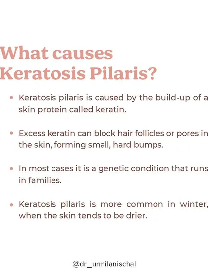 This image introduces the topic of Keratosis Pilaris, a common but often misunderstood skin condition characterized by dry, rough patches and tiny bumps on the arms, thighs, or cheeks.