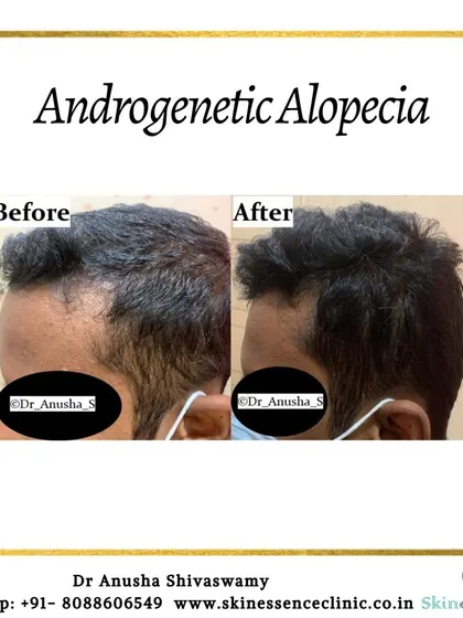This patient's primary concern was a receding hairline and thinning at the front. The 'after' image demonstrates how a targeted treatment plan can effectively restore hair density and create a stronger, more defined hairline.
