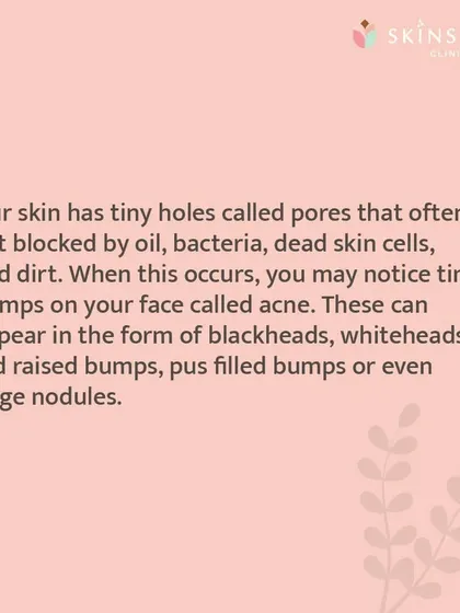 This graphic details the process of how a pimple forms. Understanding this helps in realizing why surface treatments alone are often not enough and a deeper, clinical approach is needed.