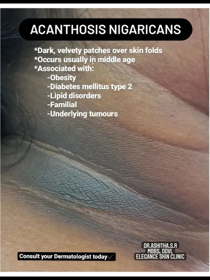 This graphic explains Acanthosis Nigricans, a condition characterized by dark, velvety patches in skin folds. It's often associated with obesity, diabetes, and other underlying issues, so a proper diagnosis is important.