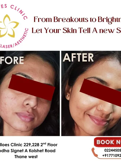 From breakouts to brightness, this transformation shows what's possible with consistent, expert care. We addressed both active acne and the lingering marks to reveal a healthier, more radiant complexion.