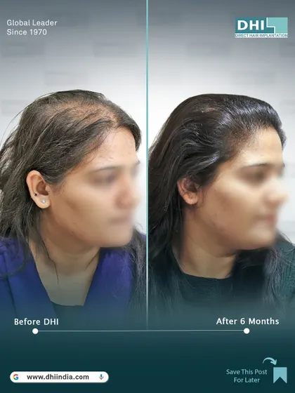 Another side-profile view of the 6-month result. This angle highlights the expertly crafted hairline that blends seamlessly with her features, showcasing the artistic skill of our DHI surgeons.