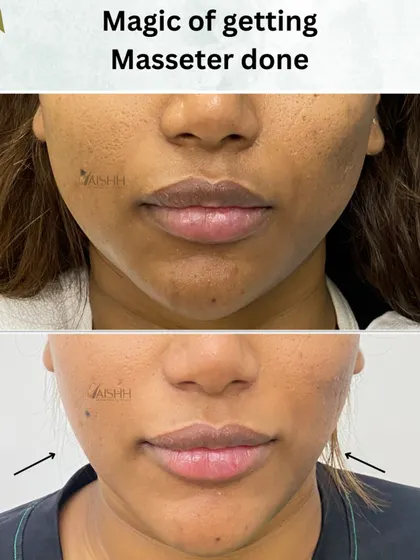 A strong, defined jawline can significantly enhance facial structure. This before and after shows the effect of a masseter treatment, which slims the lower face for a more V-shaped and contoured profile without surgery.