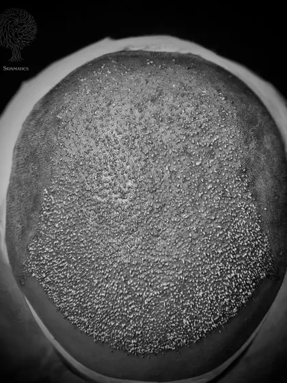 A top-down view immediately after an FUE hair transplant procedure. The density and placement of each graft are meticulously planned to ensure the final result is thick and completely natural.