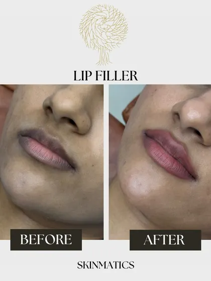 A simple lip filler treatment can make a beautiful difference. This patient wanted a subtle enhancement, and the result is a well-defined and naturally plump look.