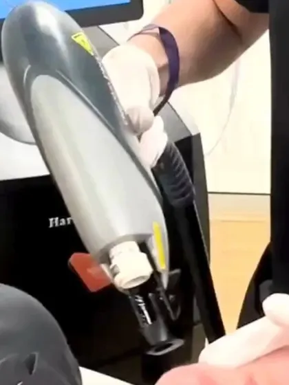 A close-up of the Alma Harmony laser handpiece. This technology allows me to address a multitude of skin imperfections, from pigmentation and acne scars to signs of ageing, by stimulating collagen and promoting skin renewal.