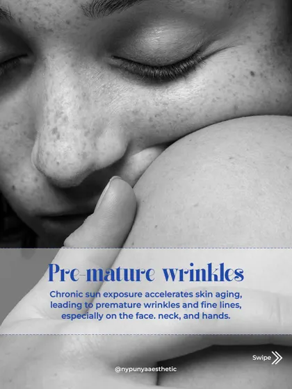 Chronic sun exposure is a leading cause of premature wrinkles and fine lines, especially on the face, neck, and hands.
