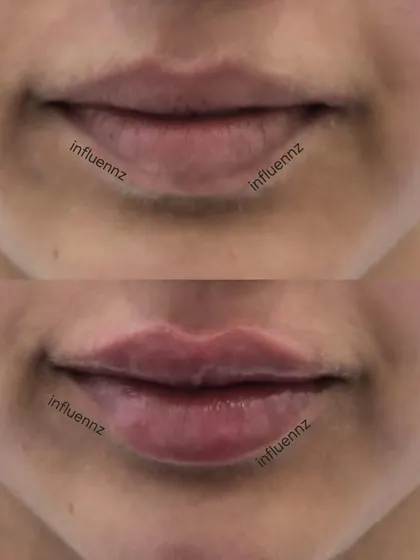 A before and after image demonstrating how lip fillers can add volume and create a more defined cupid's bow for a beautiful, balanced pout.